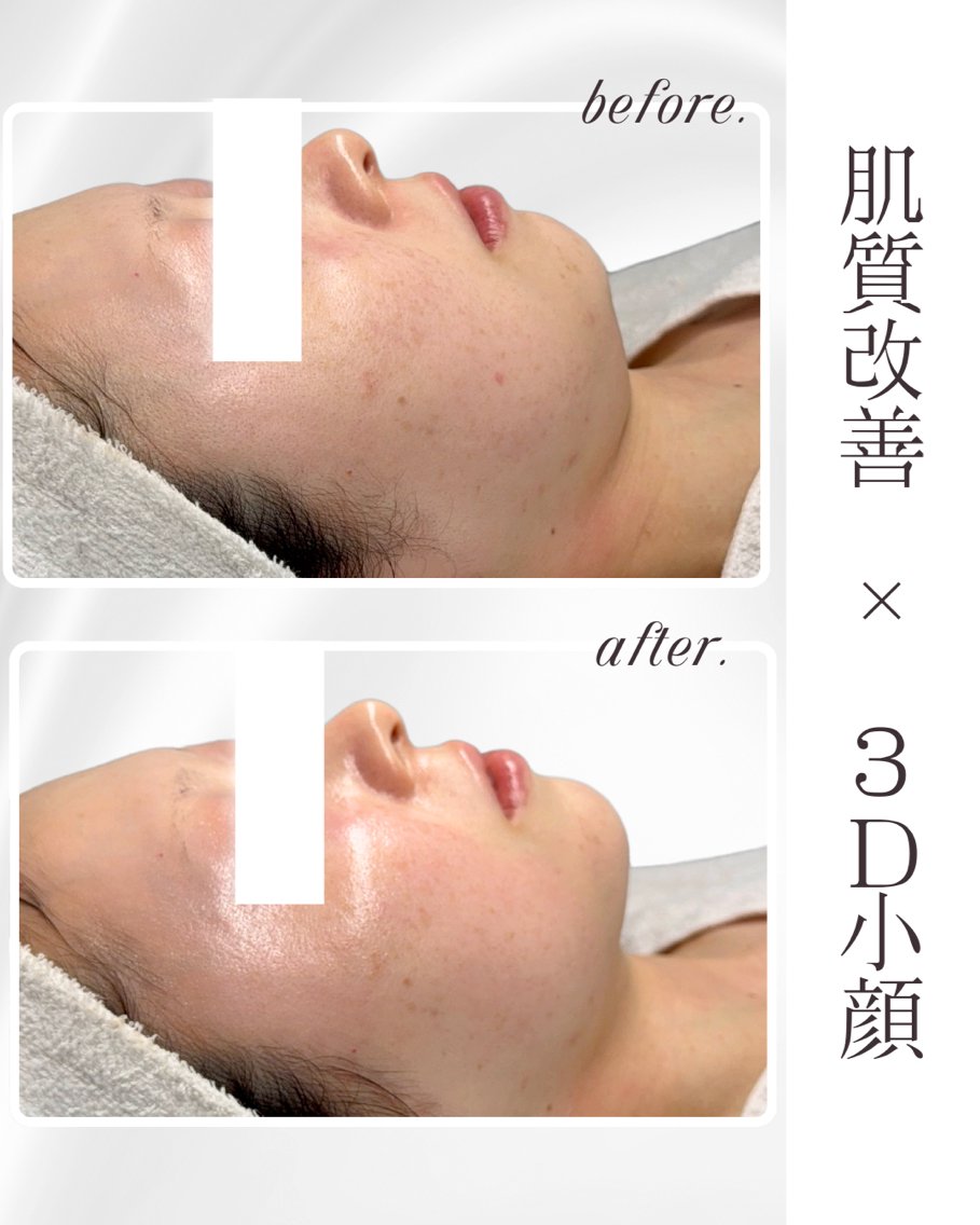 レモンボトル脂肪分解×3D小顔×ララピール レモンボトル脂肪分解 脂肪