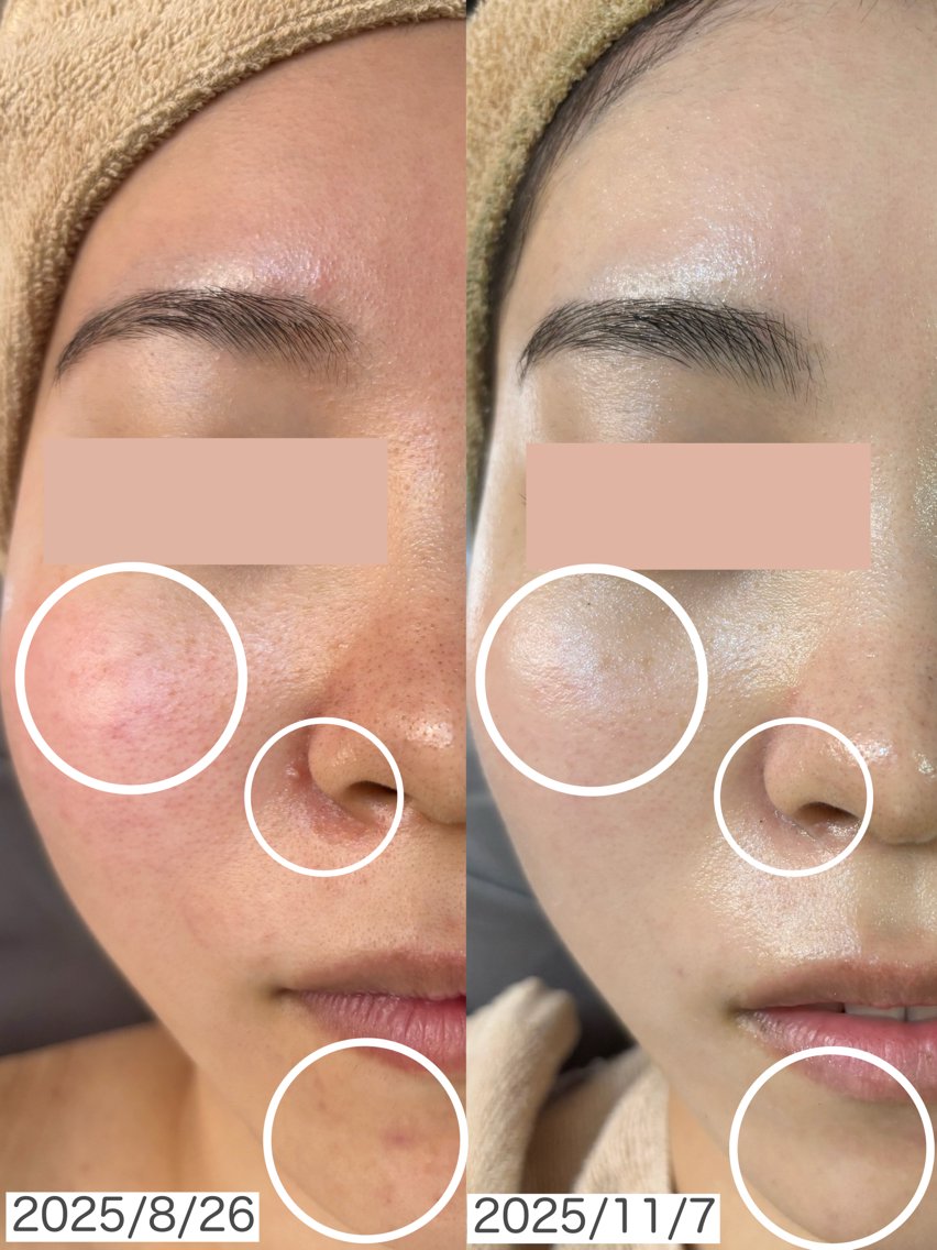 REVIハーブピーリングを4回受けていただいた方のお肌です！ しっかり