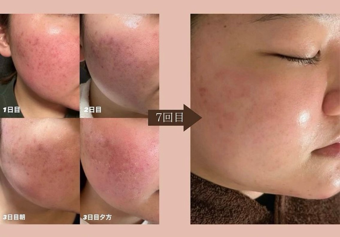 剥離ありハーブピーリング5回施術後のお写真です*ﾟ｜ぴぴのお肌