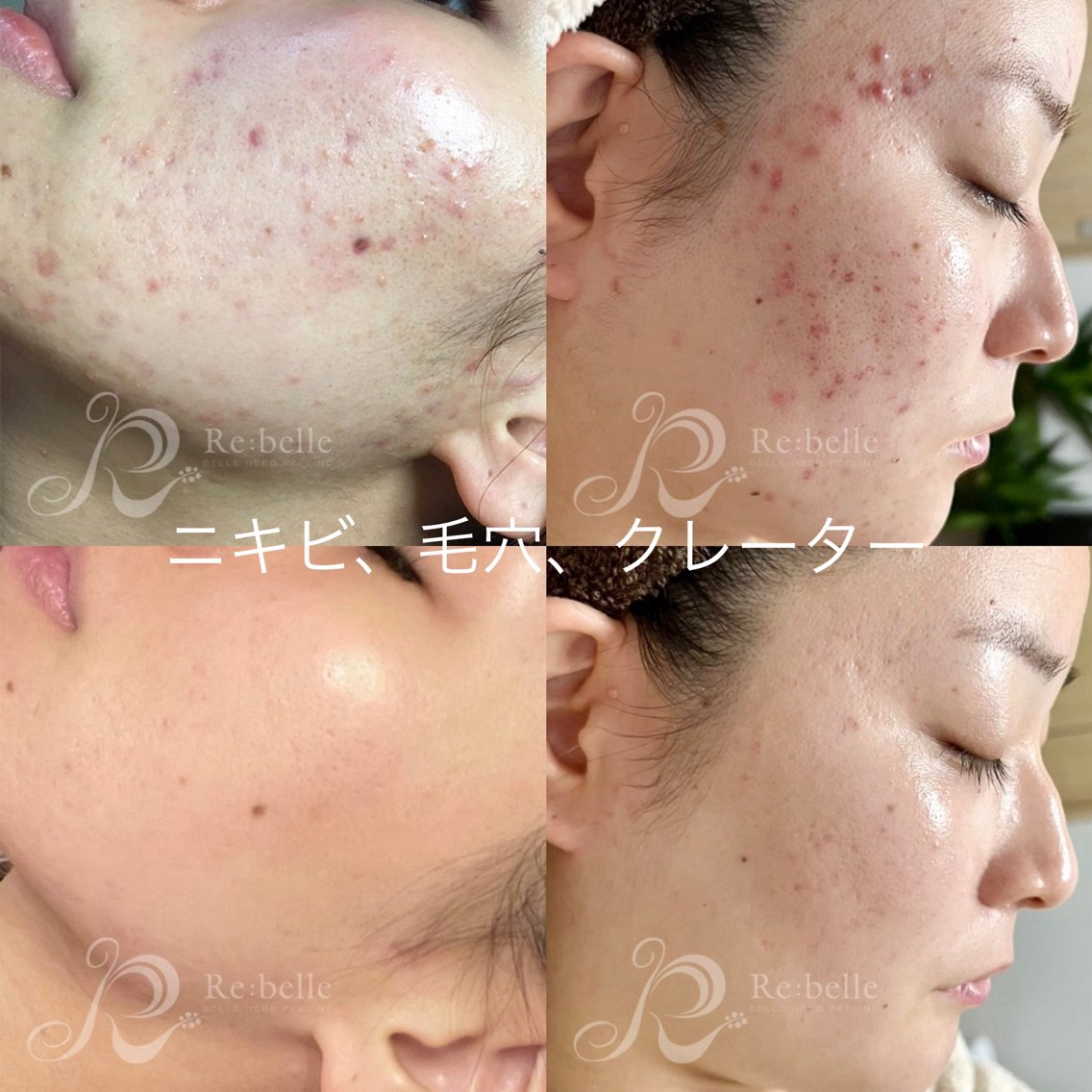 ハーブピーリング ハーブピーリング専門店-フロージア南新宿-(ハーブピーリング