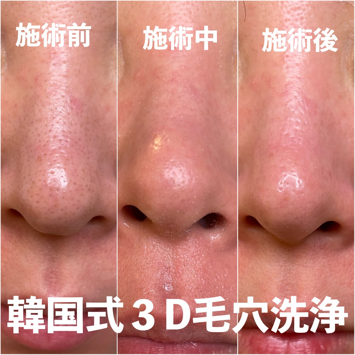 韓国式3D毛穴洗浄☆HARIKANジェル 韓国式3D毛穴洗浄☆HARIKANジェル 大人の上質 3R 韓国式3D毛穴洗浄