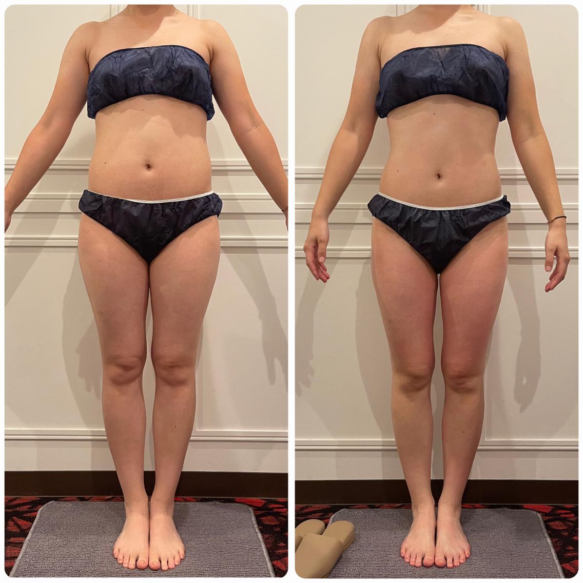 ハイパーシェイプとハイパーナイフ 株式会社ワムのハイパーシェイプ®