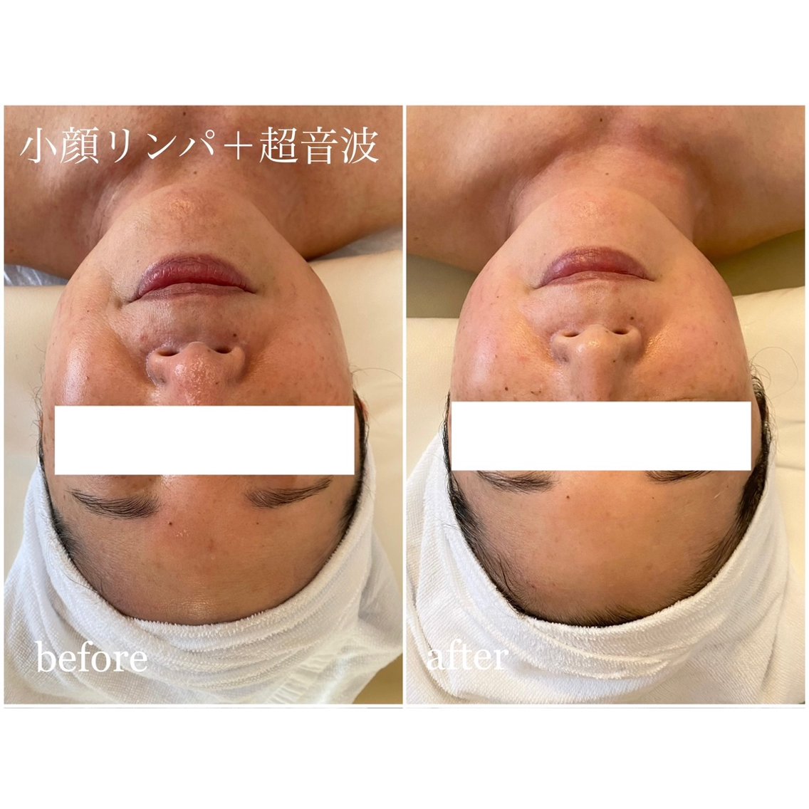 ❤エステサロン最新最先端モデル❣有効成分を皮膚の深部に深く浸透拡散