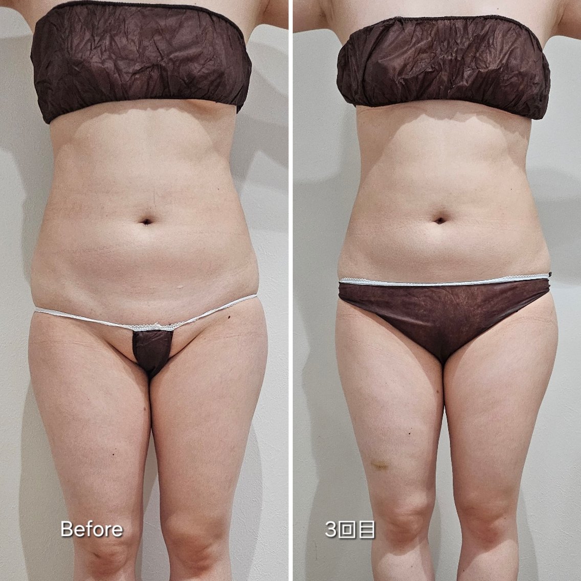 脂肪冷却　クーリング　2カップ 脂肪冷却 クーリング 2カップ 脂肪冷却 クーリング 2カップ 脂肪冷却