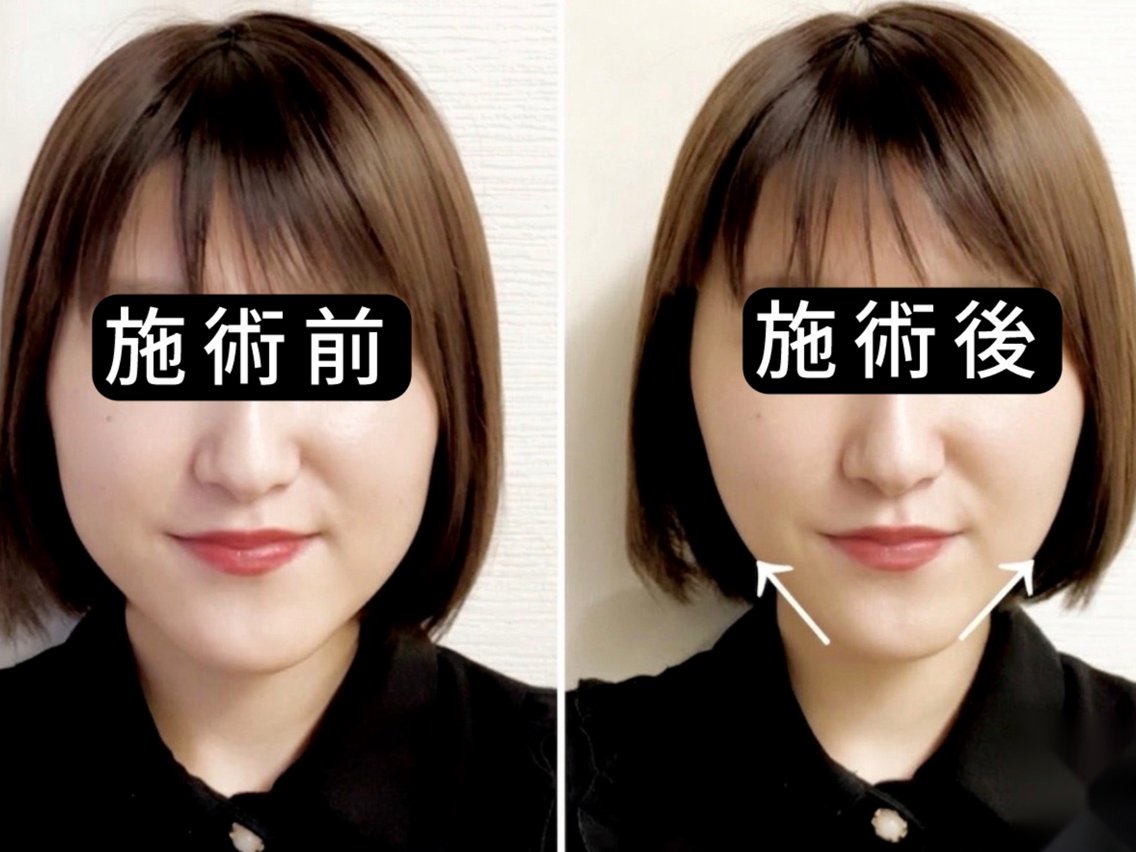 小顔美容鍼 渋谷 YZ 山崎(AOYAMA SALON YZ所属エステティシャン)の得意