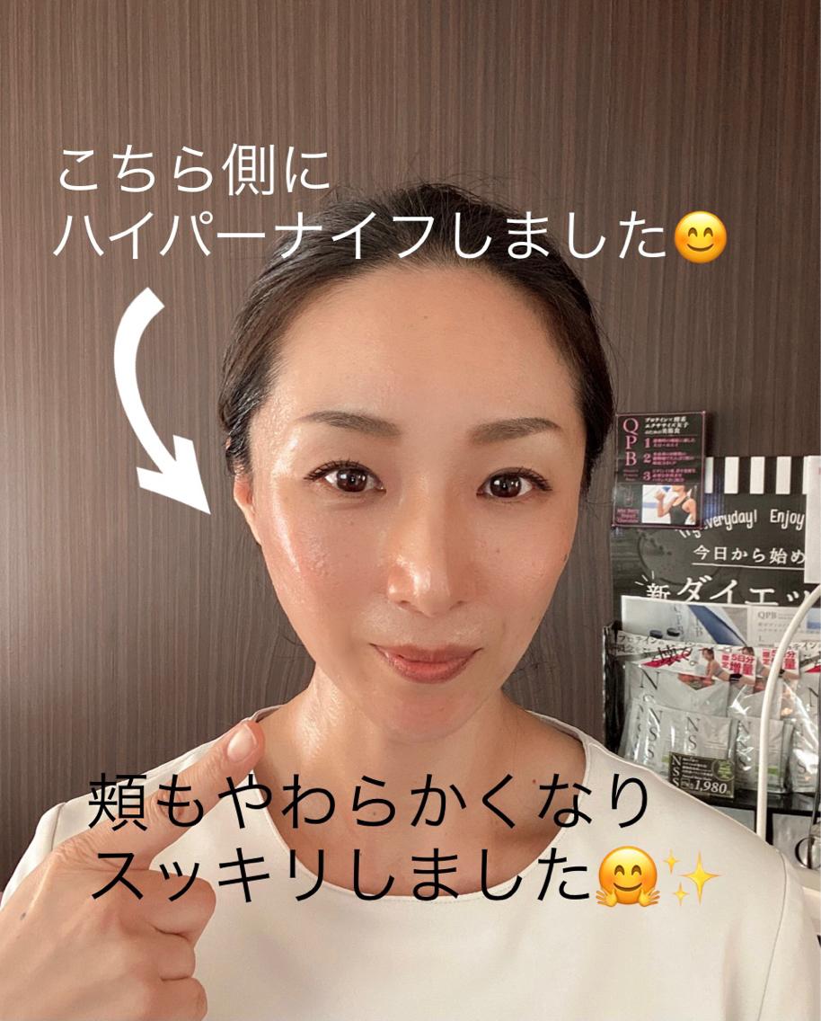 ハイパーナイフフェイシャルプロップ 1f3ea2d321dc69739bc533da499923