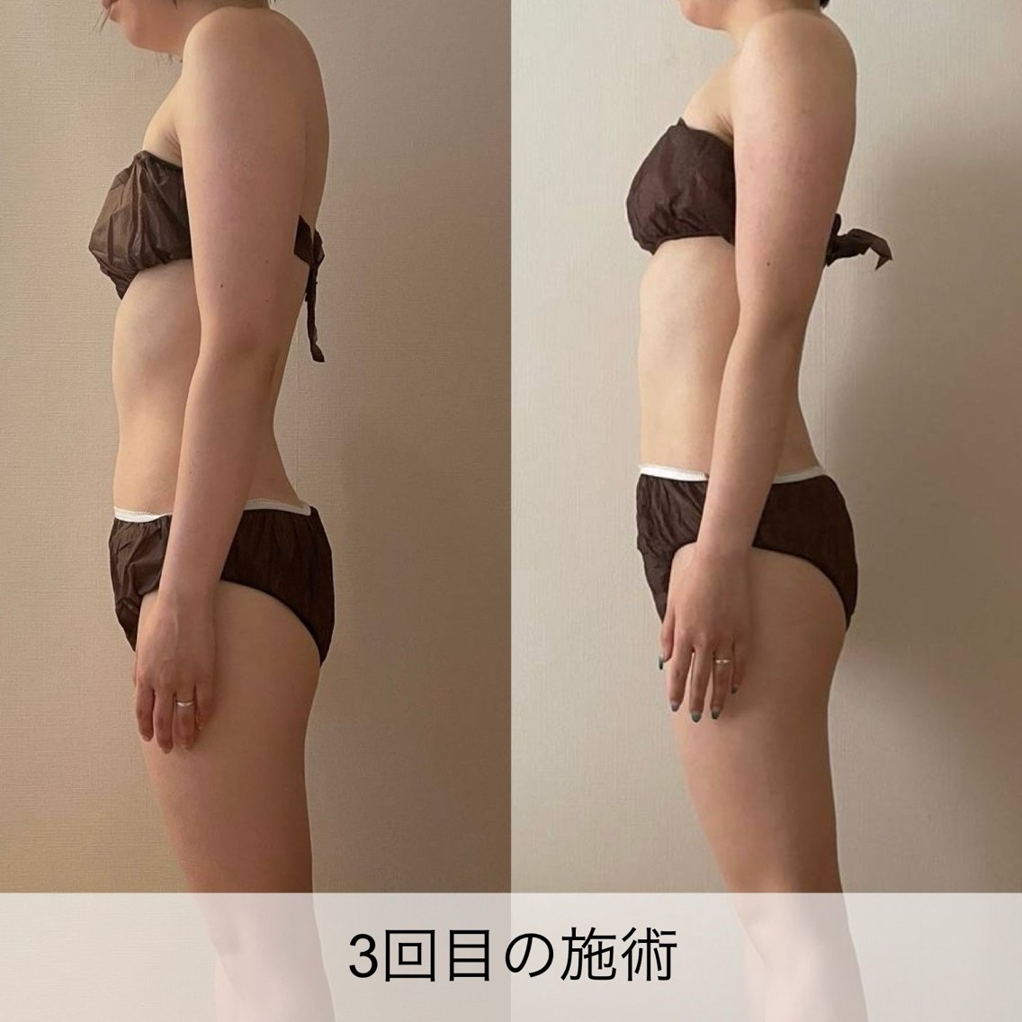 長堀橋駅近くでセルライト除去のおすすめエステ・リラク＆人気