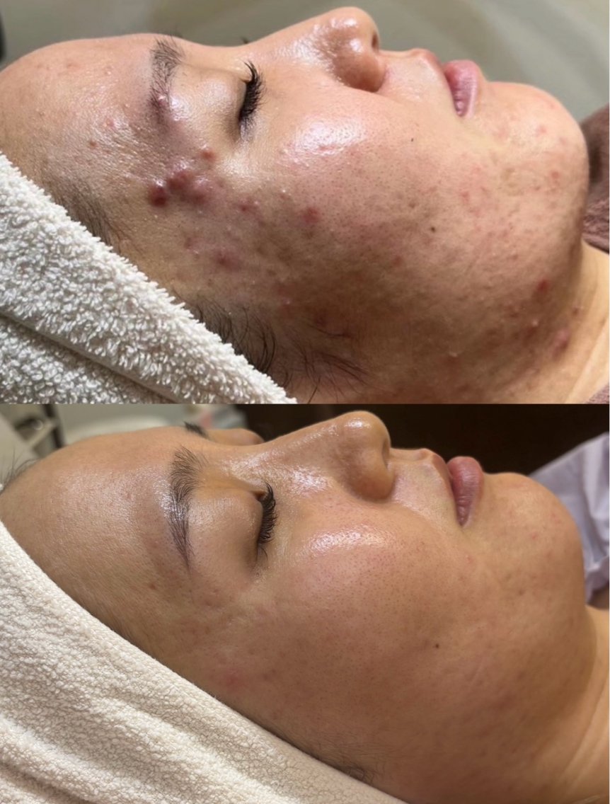 ハーブピーリング ハーブピーリング専門店-フロージア南新宿-(ハーブピーリング