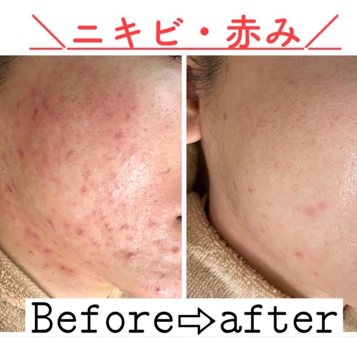 肌質改善エステサロン♡様あ専用 ぴあせる