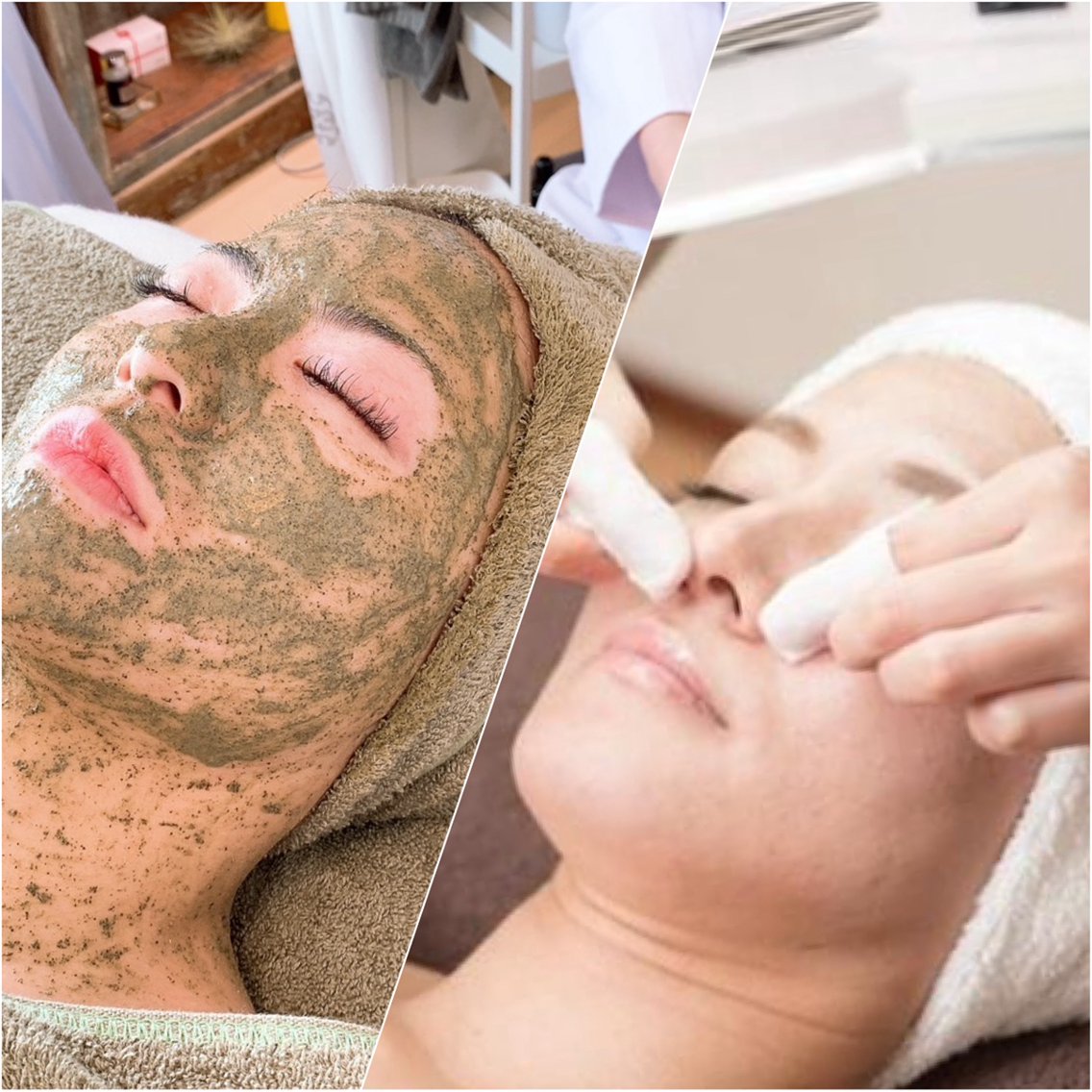 ニキビ毛穴改善 ハーブピーリング(self-caresalon1/fゆらぎ所属