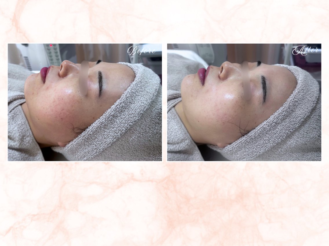 ピーリング・毛穴| soina神楽坂(s o i n aララピール／毛穴／小顔／水