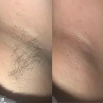 足立区 脱毛 エステ リラクサロン お得に予約するなら ミニモ