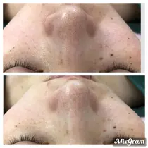 毛穴洗浄 エステ リラクサロン お得に予約するなら 8ページ目 ミニモ