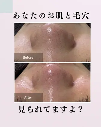 肌質改善エステサロン♡ 肌管理って1回でも効果あるの？🤔✨ 正直に言うと、本当の“肌質