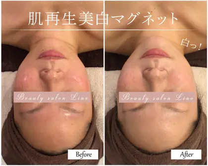 エステ版水光注射のビフォーアフター 6日目のお客様 お肌の根本的な土台ができているので 艶々で乾 Beauty Salon Lino フェイシャル 所属 Lino 小顔水光ジェット のエステ リラクカタログ ミニモ