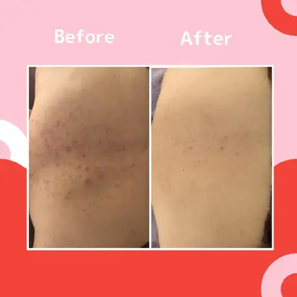 肌トラブル改善専門店accueil所属 創設50年の老舗 ニキビケア専門店のメニュー ミニモ