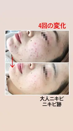 Ledライトは美容に効果抜群なんです 青い光はアクネ菌殺菌 ニキビ軽減 皮脂分泌を抑える 毛穴収縮 スキンプロサロン 大人ニキビ ニキビ跡 背中ニキビケア 所属 ハーブピーリング スキンプロサロンのエステ リラクカタログ ミニモ