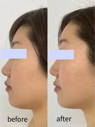 フェイスラインのむくみ たるみもすっきり 頬の位置が上がるので 顔全体がシャープに 肌も明るくト Pola A Hum あうん 中津店 所属 Pola A Hum あうん 中津店のエステ リラクカタログ ミニモ