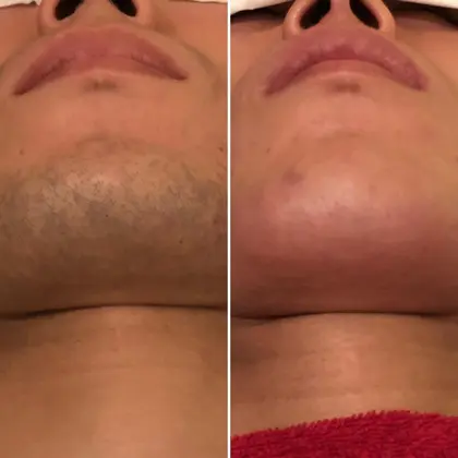 ワックス脱毛と眉メイクで 石原さとみさん風の 柔らかい曲線でふわっと色づいたような仕上がりに 眉周 サロン ド シャインtokyo所属 サロンドシャイン 南青山のエステ リラクカタログ ミニモ