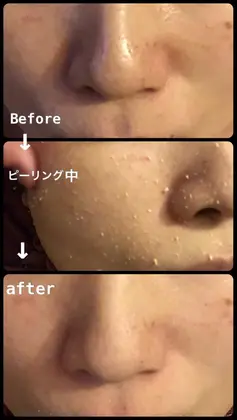 アトピーで悩んでいた方もすっかり綺麗なお肌に 好転反応が強く出る場合がございますので あらか 痩身サロン所属 ガッツリ痩身 インドエステ 筋膜のエステ リラクカタログ ミニモ