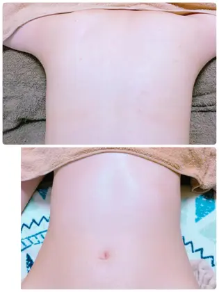 ニキビ跡 アトピー後の皮膚 お悩みの方 スタッフまで お声掛けください 美シャイン所属 根岸 もえ子のエステ リラクカタログ ミニモ