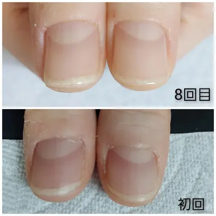 アトピーお持ちのお客様ですが 爪はもちろん指も手もつるんと綺麗になりました Nail Salon Rufu所属 Nail Salon Rufu ルフ の ネイルデザイン ミニモ アトピーお持ちのお客様ですが 爪はもちろん指も手もつるんと綺麗になりました Nail Salon Rufu所属 Nail Salon Rufu ルフ の ネイルデザイン ミニモ