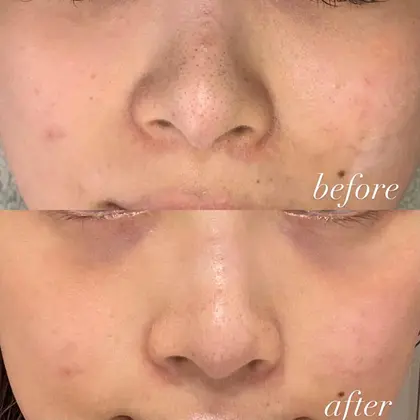 ベルベットスキンのビフォーアフターお写真になります毛穴が小さくなり 頬のニキビ跡が順調に改善してい Nurse Salon所属 柴田 ゆりあのエステ リラクカタログ ミニモ
