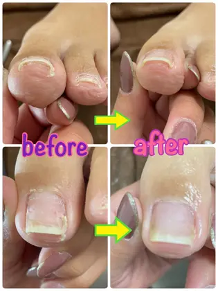 足の第二趾の爪が斜めに伸びる変形爪です 真っ直ぐ伸びるようにサポートし 理想の爪に近づけていきます Lasia Eyelash Nail所属 Lasia Natsukiのネイルデザイン ミニモ