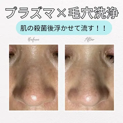 ハイドラフェイシャル【毛穴洗浄・プラズマ】