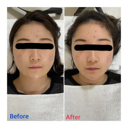 プライベートサロンmoyo所属 ハイフ 小顔矯正 筋膜リリースのメニュー ミニモ プライベートサロンmoyo所属 ハイフ 小顔矯正 筋膜リリースのメニュー ミニモ