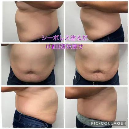 魔法の痩身ジェル＝針無し脂肪溶解ジェルはクリニックで大人気の脂肪 