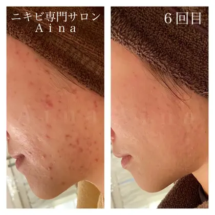 ニキビ ニキビ跡専門サロンａｉｎａ所属 ニキビ改善サロン 益子早百合のエステ リラクカタログ ミニモ