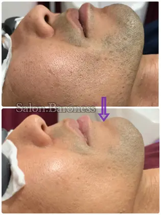ヒゲ脱毛 メンズ脱毛も植物幹細胞の美肌ケア付き コラーゲンやヒアルロン酸などの美容成分を Salon Baroness サロンバロネス所属 上級脱毛士 Marineのエステ リラクカタログ ミニモ