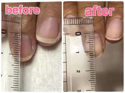 2ヶ月の育成期間でネイルベッド ピンクのところ が大きくなりました 縦長爪へ成長中 烏丸御池 Plaisir Nail プレジール所属 山崎 みゆきの ネイルデザイン ミニモ 2ヶ月の育成期間でネイルベッド ピンクのところ が大きくなりました 縦長爪へ成長中 烏丸御池 Plaisir Nail プレジール所属 山崎 みゆきの ネイルデザイン ミニモ