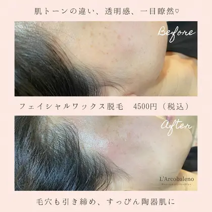 セルフお手入れが難しい部位は ワックスにお任せあれ もみあげワックス脱毛のビフォーアフター L Arcobaleno ラルコバレーノ 所属 ワックス脱毛と ドライヘッドスパのエステ リラクカタログ ミニモ