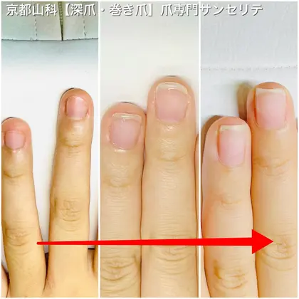 子供の頃から爪噛みがやめられなかったお客様 深爪ケアを集中的にされ 見事爪噛みを克服 爪も見違 ネイルサロン サンセリテ所属 巻き爪 トラブル爪 専門サンセリテのネイルデザイン ミニモ