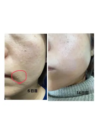 人気のボタニカルピーリング約一週間でモチモチの柔肌に 繰り返し行う事で気になっていた箇所が見違え Eyelash Laxbe 2sk8 所属 Takahashi Asamiのマツエクデザイン ミニモ