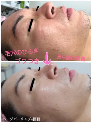 毛穴のひらき 赤ら顔 ゴワつき 全てに効果的ハーブピーリング 結果は一目瞭然 1ヶ月 Me 所属 Me 和田のエステ リラクカタログ ミニモ