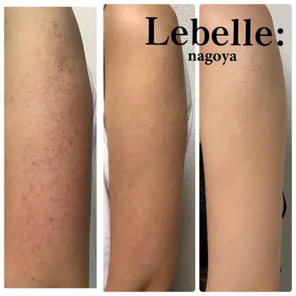 毛孔性苔癬とは 症状 思春期をすぎたあたりから 肩から二の腕の外側にかけて 上腕の外側 あ ハーブピーリングrebelle 名古屋所属 まつげパーマ専門店 リベル式リフト のマツエクデザイン ミニモ