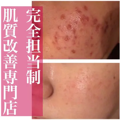 1回のお手当とミネルヴァ化粧品を1カ月使った効果です 肌トラブル改善専門店accueil アクール 所属 肌トラブル改善専門店 齋藤のエステ リラクカタログ ミニモ