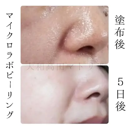 写真をタップして拡大で毛穴を見てください 黒ずみわかりますか？ 毛穴 
