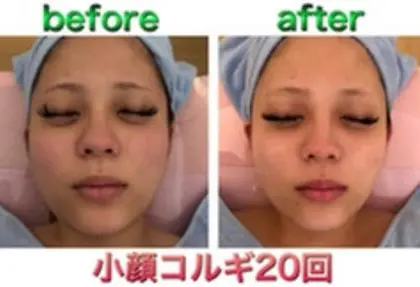 小顔コルギ 骨気 のビフォーアフターです 本文 こんにちは 小顔コルギの回ビフォーアフタ ハイパーナイフ痩身 小顔コルギ ハーブピーリング K Beauty 東新宿所属 さいとう かずみのエステ リラクカタログ ミニモ