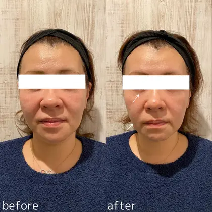 リブセラプラズマフェイシャル初回beforeafter 一度の施術で目の下のくぼみと ほうれい線 Iris Esthetic Salon所属 毛穴 肌質改善サロン Iris Sakiのエステ リラクカタログ ミニモ リブセラプラズマフェイシャル初回beforeafter 一度の施術で目の下のくぼみと ほうれい線 Iris Esthetic Salon所属 毛穴 肌質改善サロン Iris Sakiのエステ リラクカタログ ミニモ