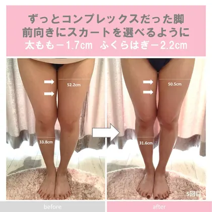 太もものハリを解消したい 脚のむくみ 太もものハリにお悩みのお客様の Before Af セルフエステ Beauty Sharing 表参道 所属 表参道 原宿 セルフエステのエステ リラクカタログ ミニモ