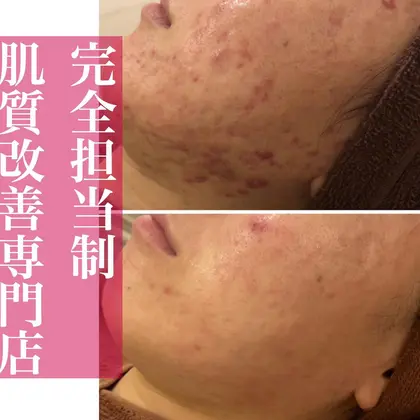 1回のお手当とミネルヴァ化粧品を1カ月使った効果です 肌トラブル改善専門店accueil アクール 所属 肌トラブル改善専門店 齋藤のエステ リラクカタログ ミニモ