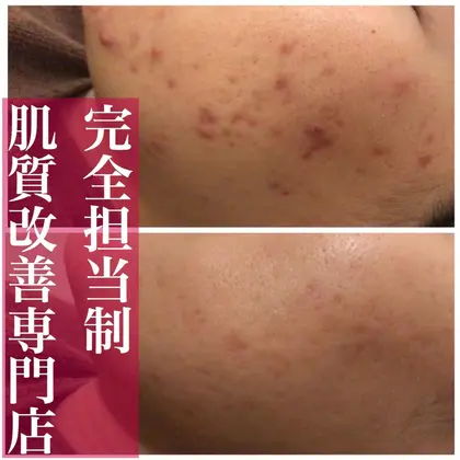 1回のお手当とミネルヴァ化粧品を1カ月使った効果です 肌トラブル改善専門店accueil アクール 所属 肌トラブル改善専門店 齋藤のエステ リラクカタログ ミニモ