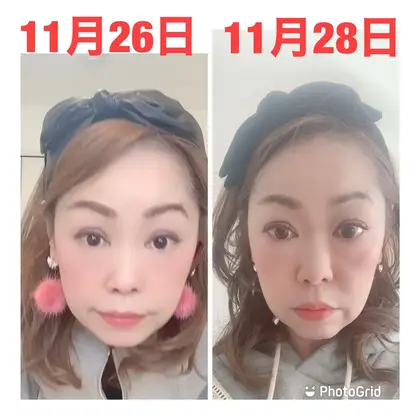 こんばんは 小顔矯正行いました 一度きりで終わる小顔矯正 写真ok出ましたので載せさて頂き まつもと施療院所属 松本 昌也のエステ リラクカタログ ミニモ