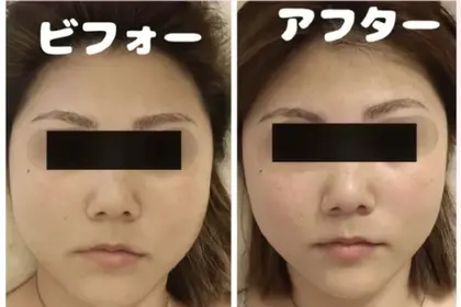 プラズマニードル カリファ 赤