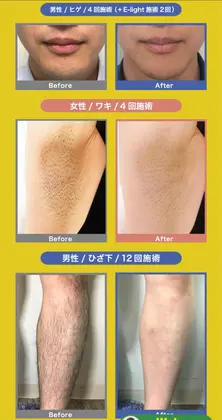 最新脱毛機は 驚異の全身15分と最速で脱毛が完了 日焼け肌 タトゥー ほくろも照射可能 安全だか Totalbeautylounge花香所属 Matsuo Eriのヘアカタログ ミニモ