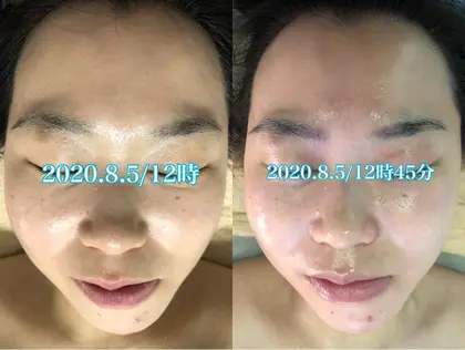 45分で毛穴レス 艶出し むくみとり小顔効果 週1のお手入れで効果持続率up ハンドフェイシャ E Style Umeda所属 オオスギ カオリのエステ リラクカタログ ミニモ